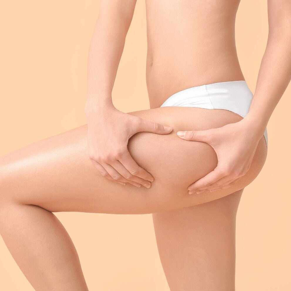 Persona che pizzica coscia e glutei per mostrare cellulite