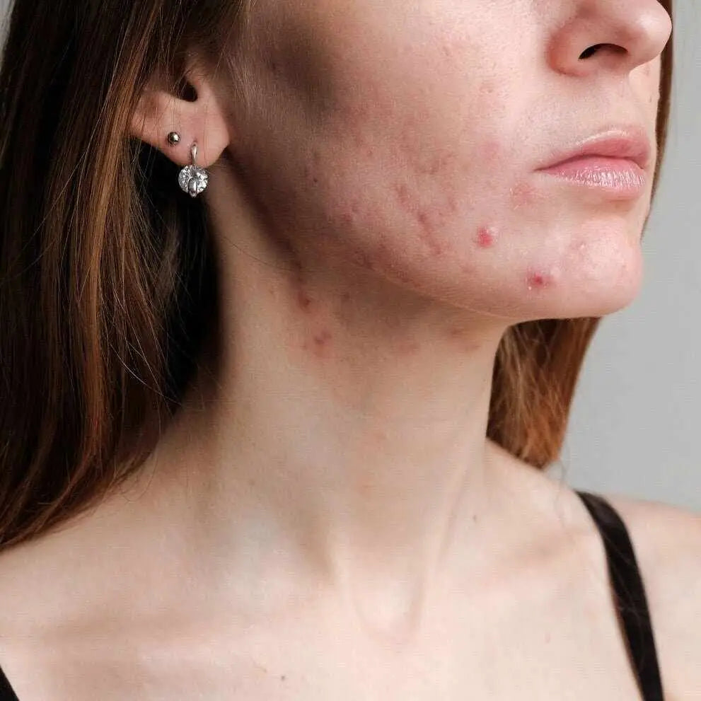 Viso e collo di donna con acne e cicatrici evidenti