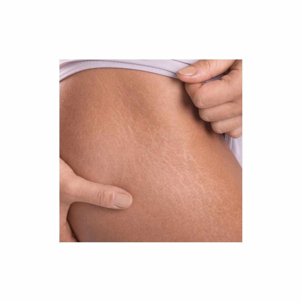 Pelle con smagliature visibili da prevenire per una pelle di seta