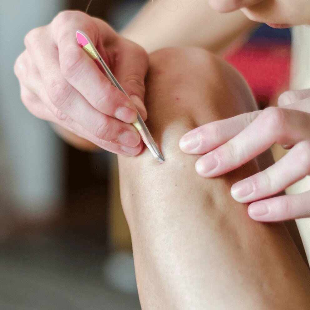 Peli incarniti: cause, rimedi e prevenzione - Il mio negozio