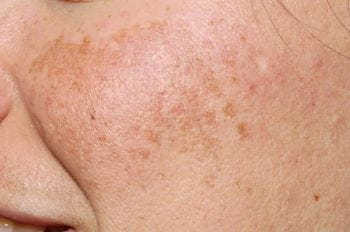 melasma.jpg