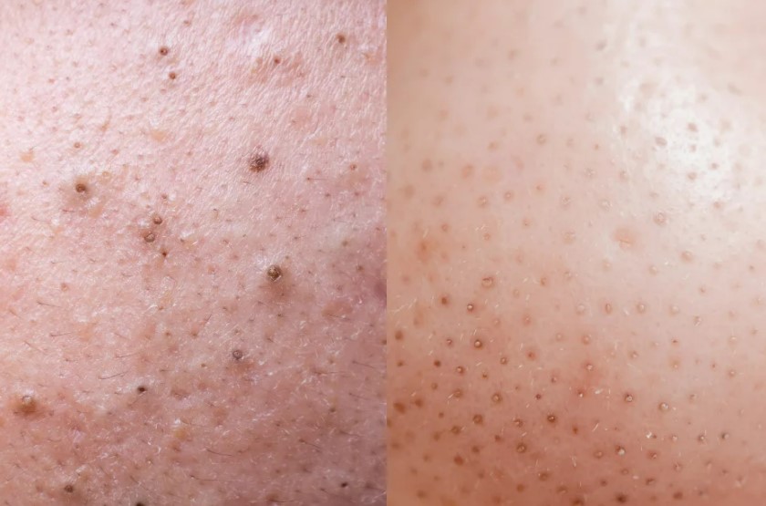 punti-neri-filamenti-sebacei.jpg