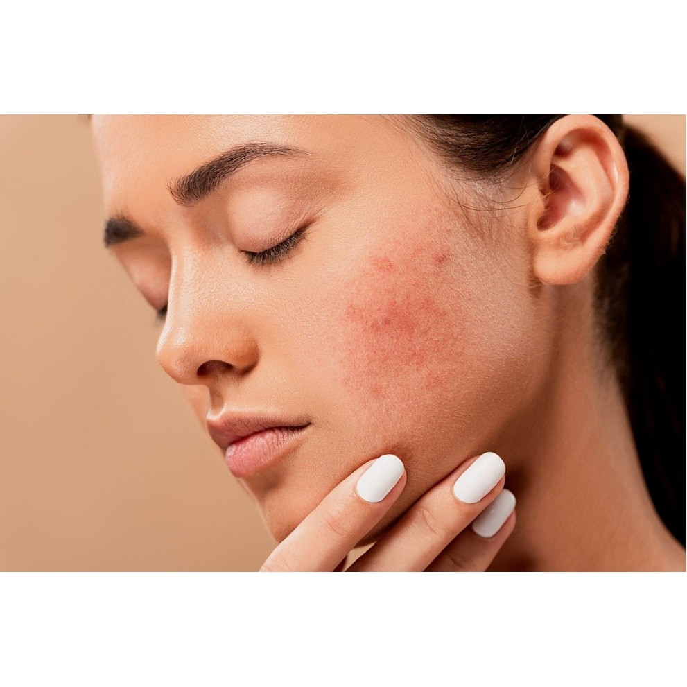 Acne Rosacea sul Viso: fattori scatenanti e rimedi naturali